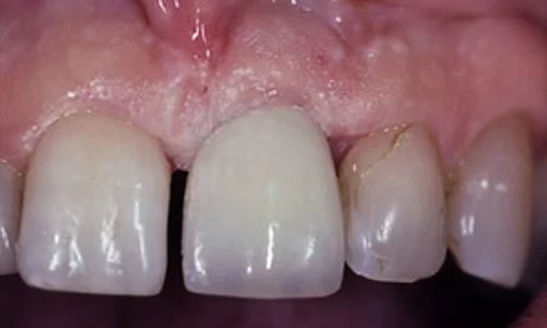 Dental Implants After