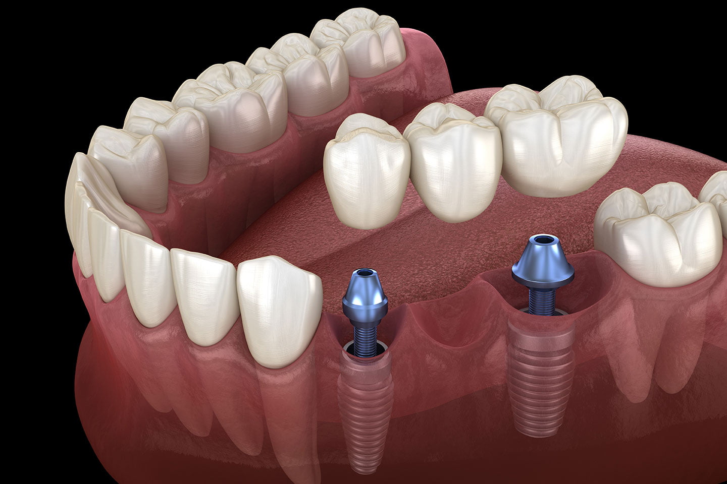 Dental Bridge Vs Implant Pros And Cons And How To Choose Somerset 