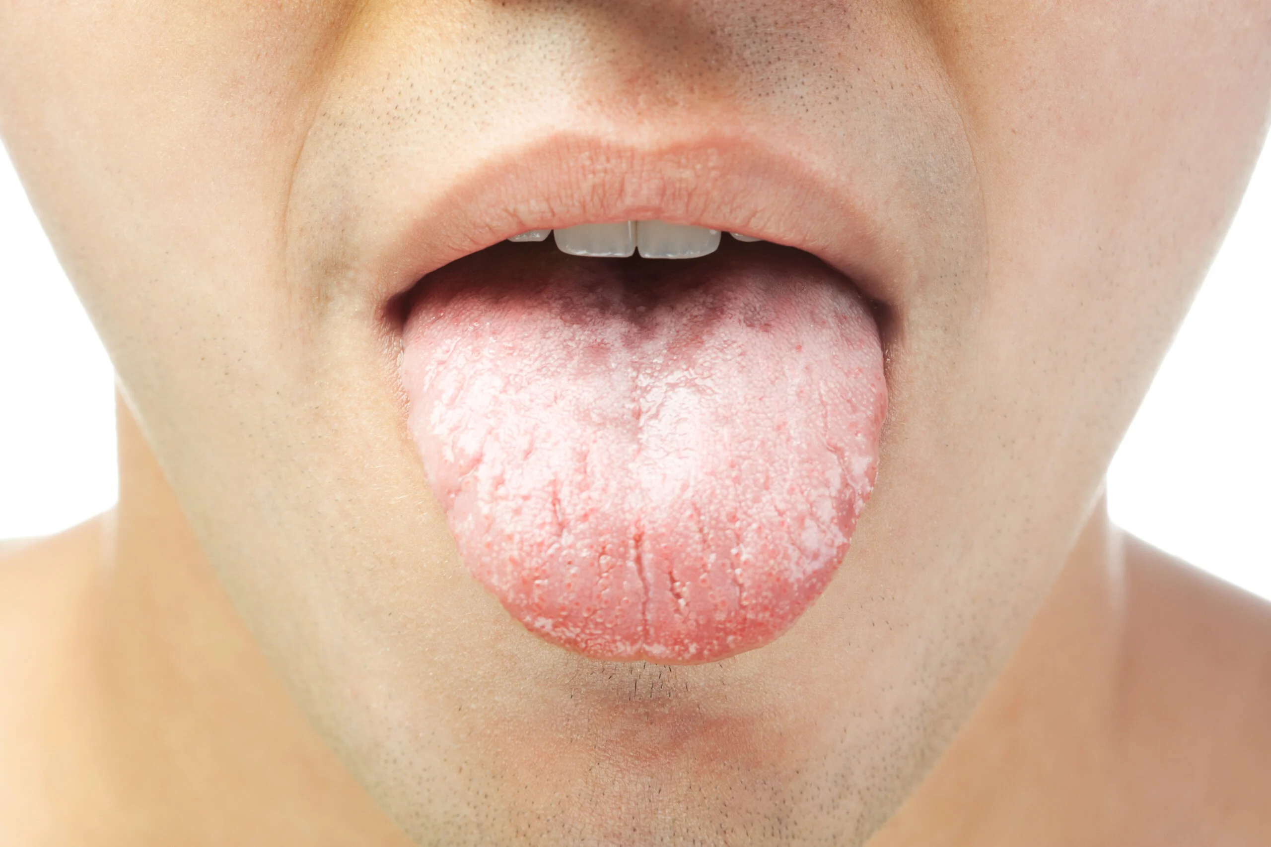 Causes and Symptoms of Dry Mouth