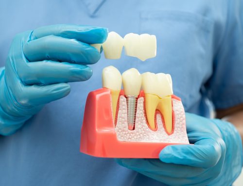 Understanding the Types of Dental Crowns: Pros and Cons of Each